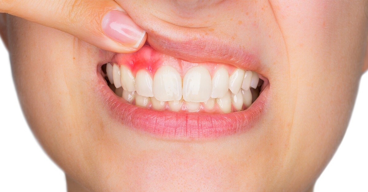 piorrea periodontitis