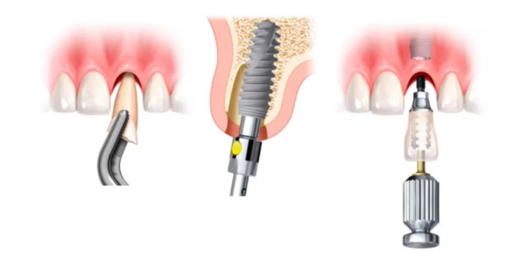carga implantes dentales almería