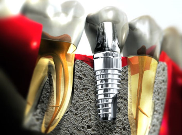 implantes dentales carga inmediata almería