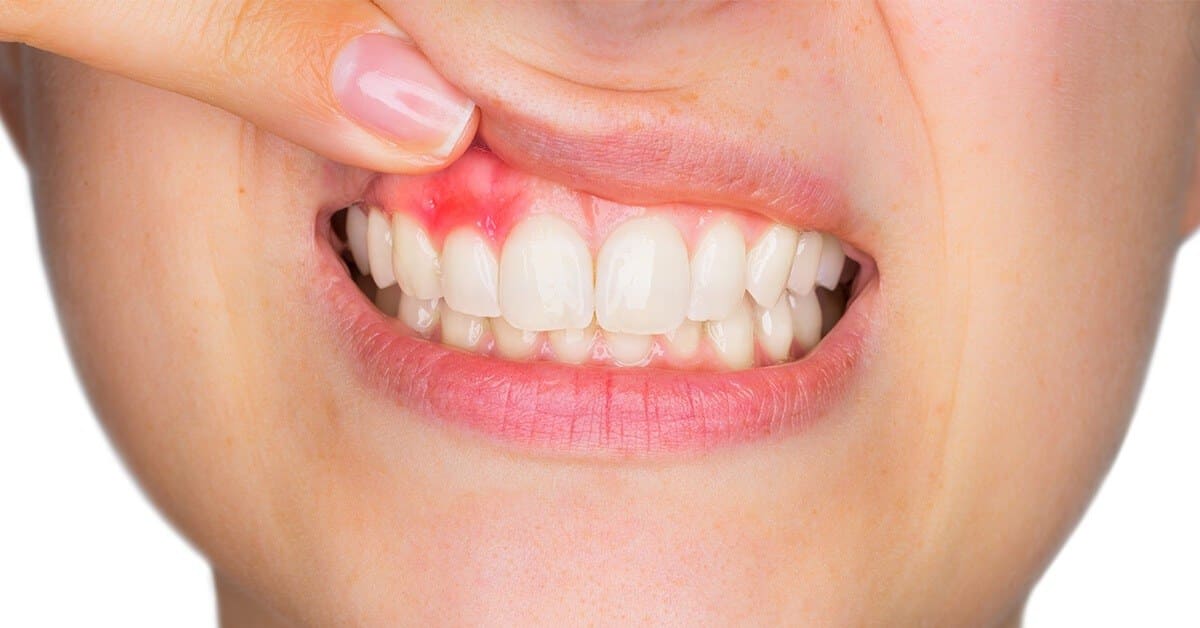 sonrisa con piorrea dental