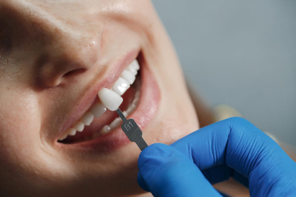 Tratamiento de carillas dentales en clínica Escámez Almería