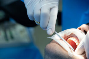 Clínica Escámez dental realiza endodoncias en Almería